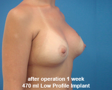 plastic-surgery-breast-augmentation